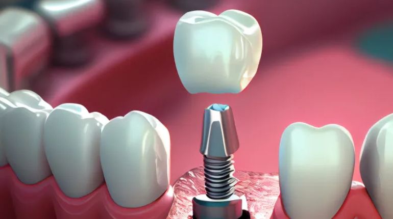 Dental Implants Cost in ahmedabad