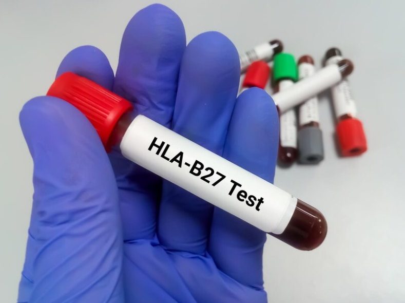 HLA B27 Test