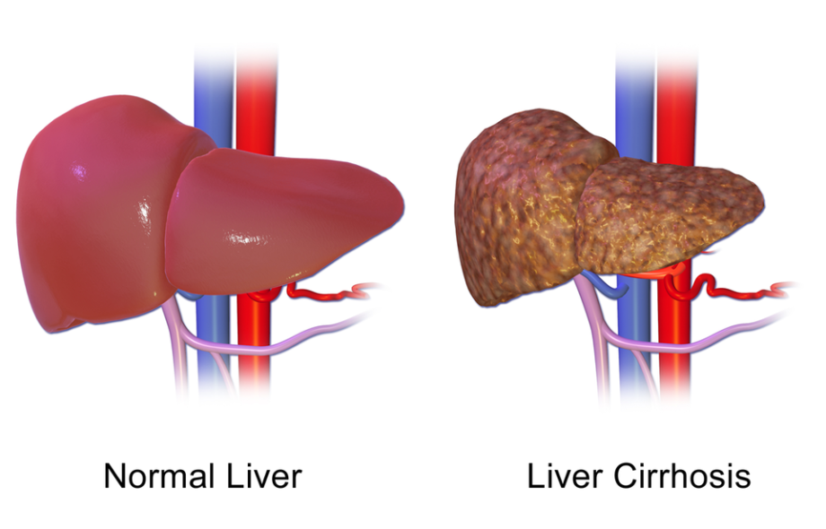 Critical Early Signs of Liver Cirrhosis You Should Not Overlook