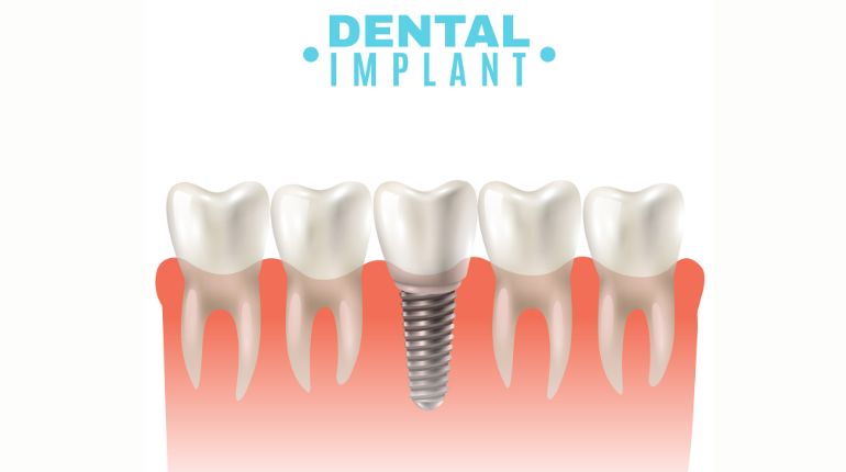 Dental Implants in Ahmedabad
