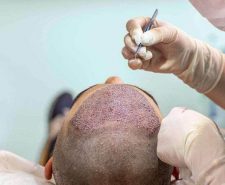 Hair transplant