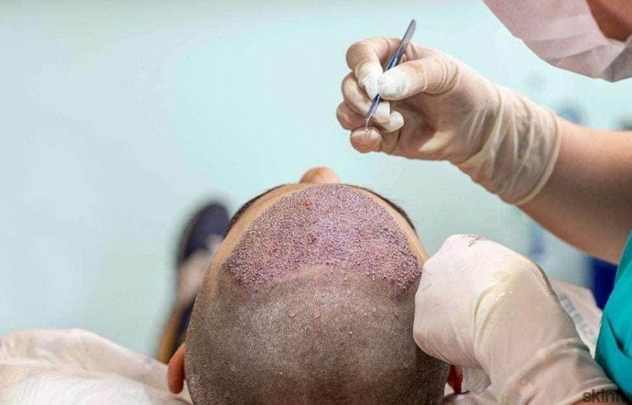 Hair transplant